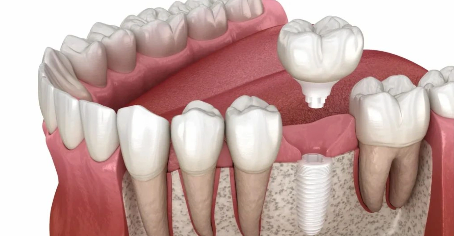 Ceramic Dental Implants 1